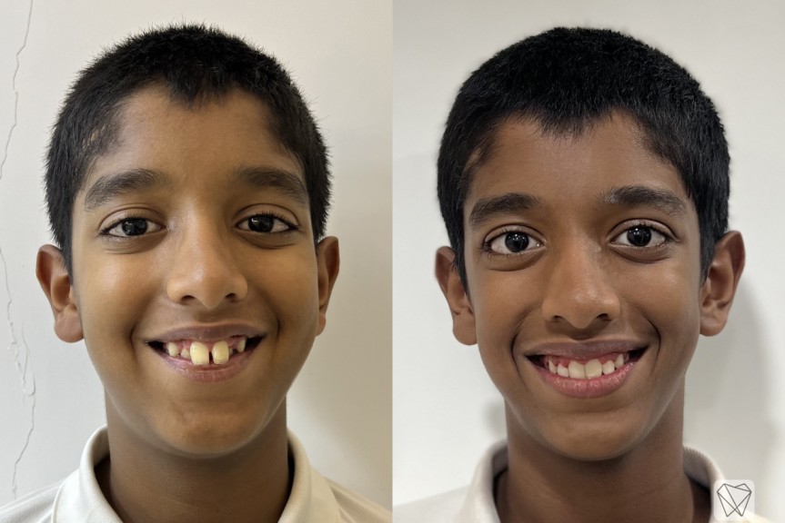 braces in baner