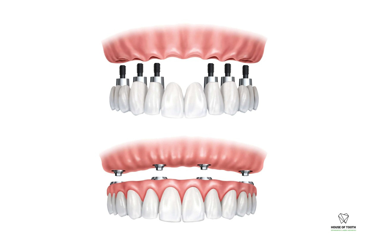 fulll mouth rehabilition at house of tooth baner