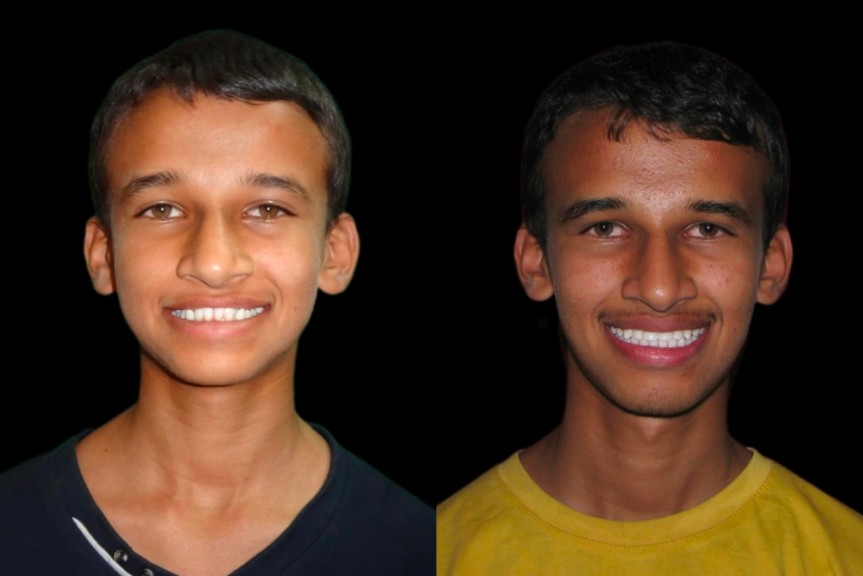 jaw correction