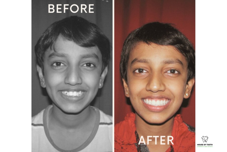 self ligating braces baner pune