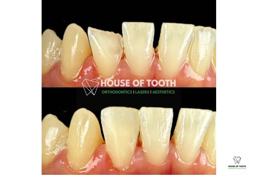 composite veneers