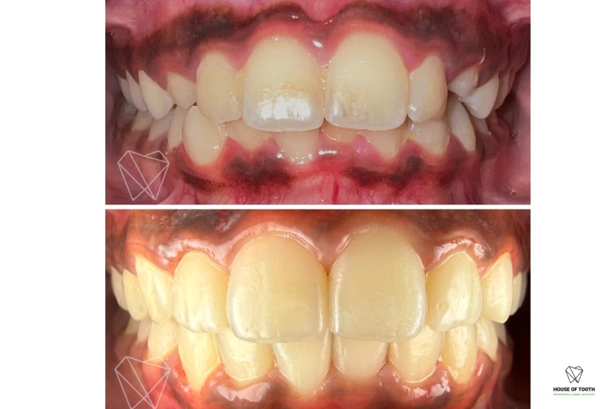 invisalign treatment baner pune