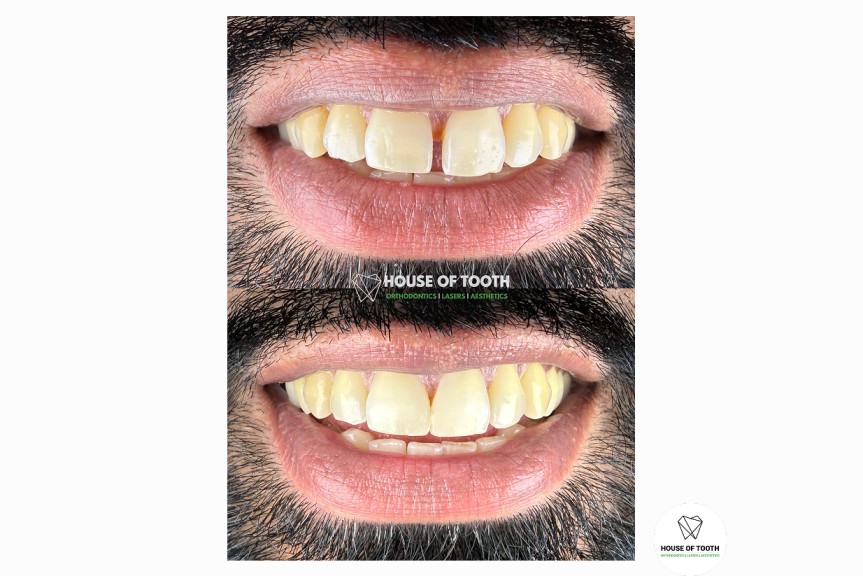 gap between teeth