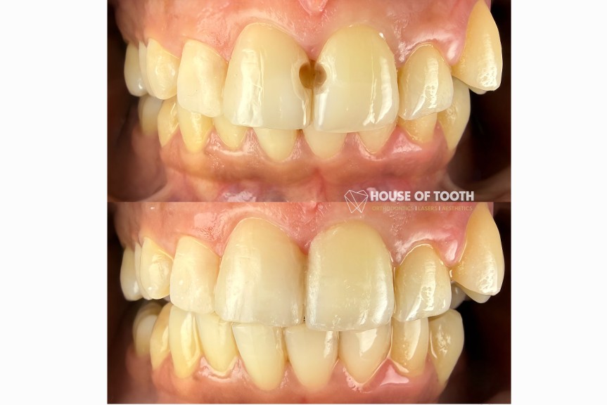 smile designing
