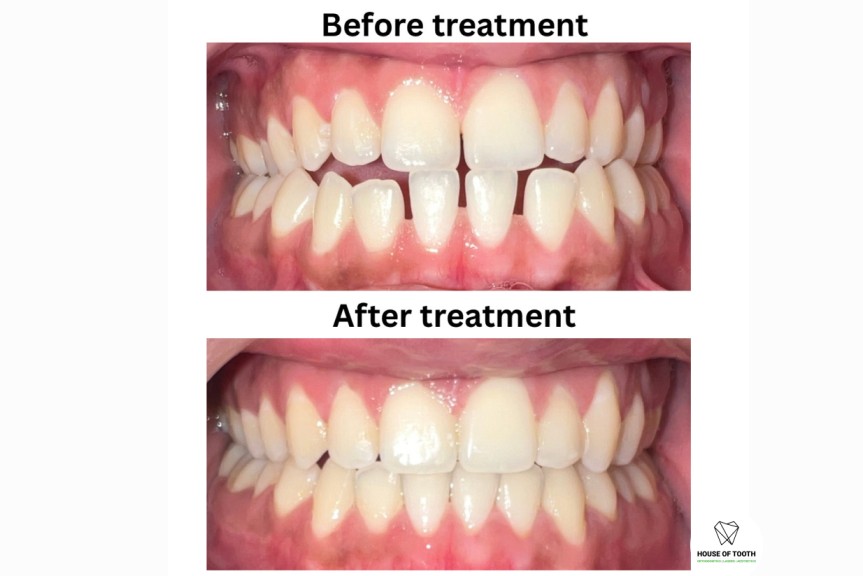 treatment of gaps with invisalign