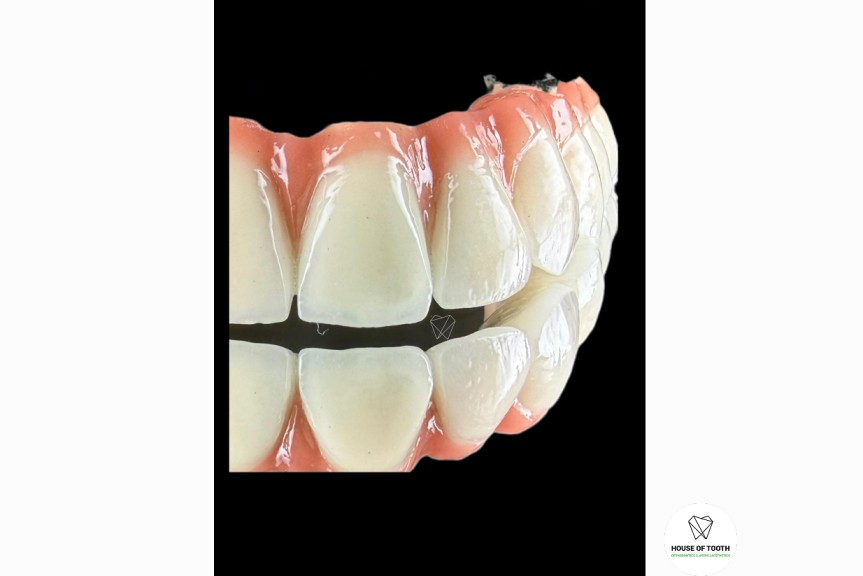 full mouth teeth replacement pune