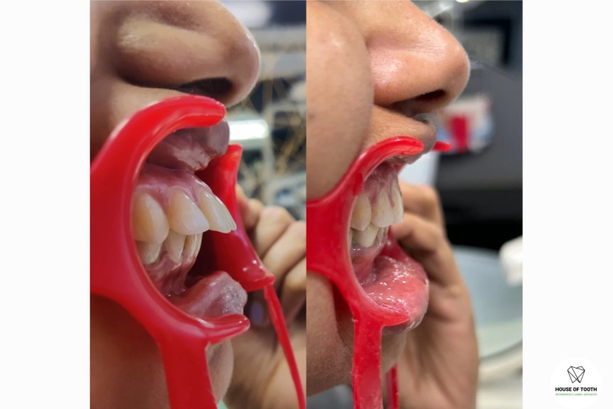 buck teeth treatment