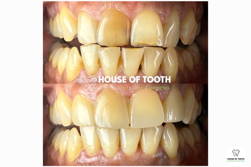 smile designing in pune