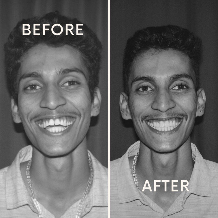 braces treatment in adults braces treatment in adults