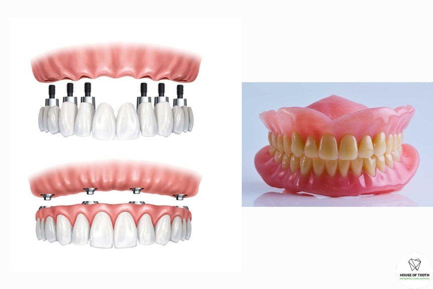 dental implants vs denture dental implants vs denture