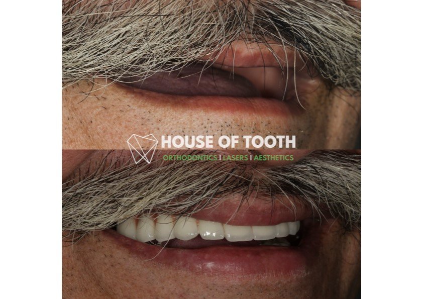 full mouth teeth replacement pune full mouth teeth replacement pune