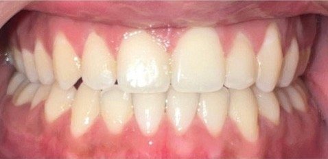 After Invisalign: gap between the front teeth closed in 11 months