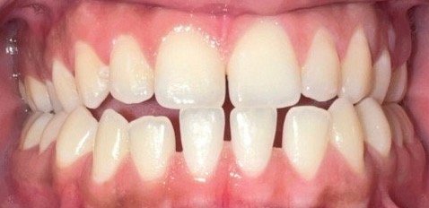 Before Invisalign: gap between the upper front teeth